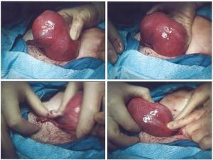 Operácia na odstránenie maternicových fibroidov, svedectvo
